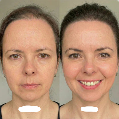 KIMÉ Glow™ – Sistema de Micro-Infusión Capilar