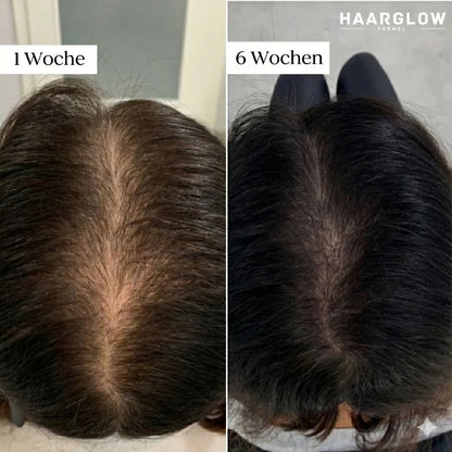 KIMÉ Glow™ – Sistema de Micro-Infusión Capilar